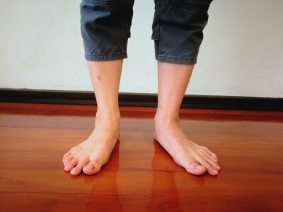 flat feet treatment